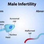 Information about the causes of male infertility