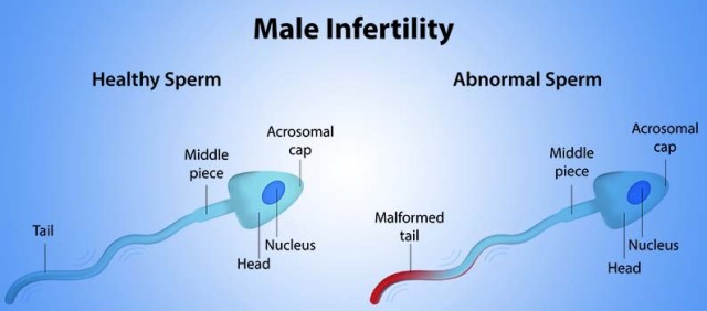 Information about the causes of male infertility